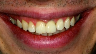 Chancen und Risiken dentaler CAD/CAM- Systeme