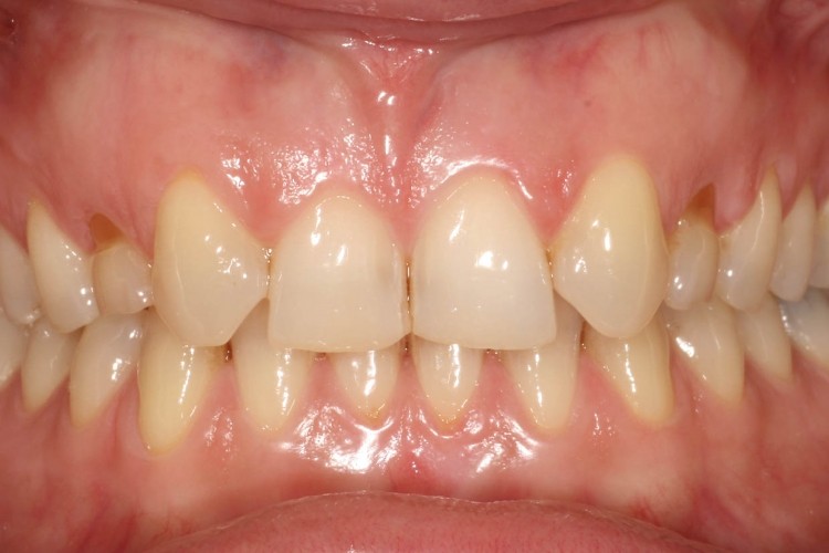 Milchzähne als erwachsener noch Zahn selber