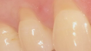 Therapie multipler gingivaler Rezessionen