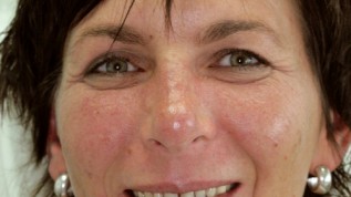 Der Zauber der MikroVeneers