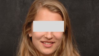 Gaumenimplantate in der Lingualtechnik