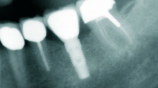 Stabile periimplantäre Gewebe auf Dauer