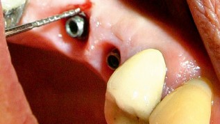 Problemfall Periimplantitis - Er:YAG-Laser hilft