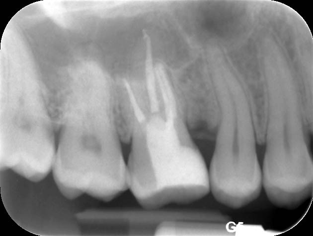 Endodontische Diagnostik Und Behandlungsplanung Zwp Online Das Nachrichtenportal Fur Die Dentalbranche