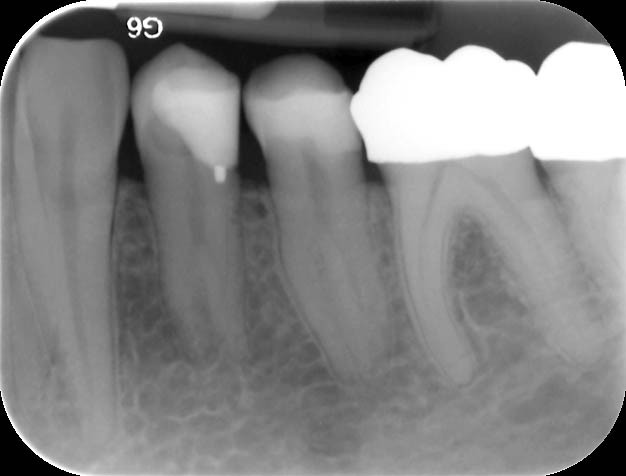 Endodontische Diagnostik Und Behandlungsplanung Zwp Online Das Nachrichtenportal Fur Die Dentalbranche