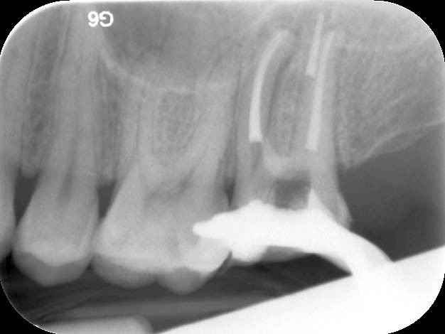 Endodontische Diagnostik Und Behandlungsplanung Zwp Online Das Nachrichtenportal Fur Die Dentalbranche