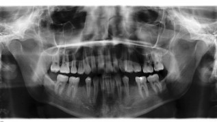 Die Optimierung des Implantatlagers
