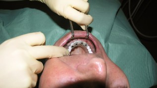 Edelmetallfreie Implantatversorgungen