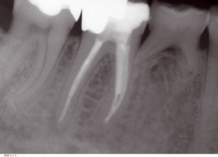 Moderne Endodontie Ein Uberblick Zwp Online Das Nachrichtenportal Fur Die Dentalbranche