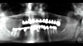 Die 3-D-gestützte Implantologie