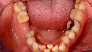 Navigierte Implantation