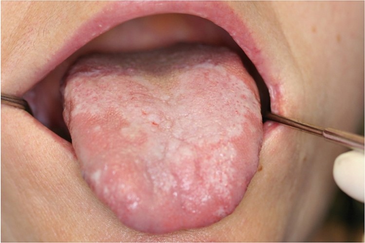 Zunge der knötchen auf Zungenkrebs: Diese