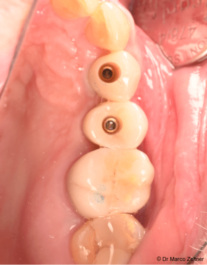 Fig. 13: Five months post- operatively, with the final prosthetic restoration in place.