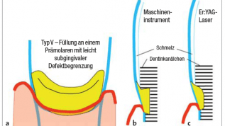 Füllungen im Zahnhalsbereich mit dem Laser