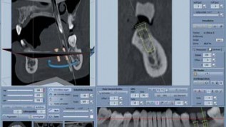 Präzise 3-D-Diagnostik und Implantatplanung