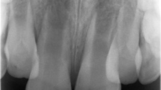 Regenerative Endodontie