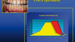 Implantat versus Parodontaltherapie