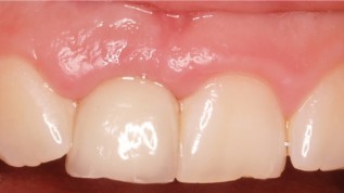 3-D-Planung und navigierte Implantation