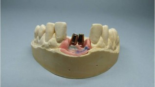 Emergenzprofil-Technik bei extremen Implantationen