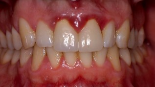 Chronische hyperplastische Gingivitis
