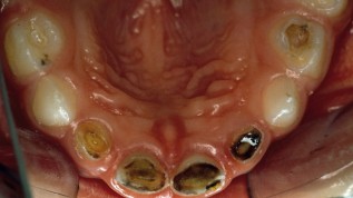 Kariesprophylaxe mit Fluoriden