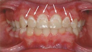 Selbstligierende Brackets