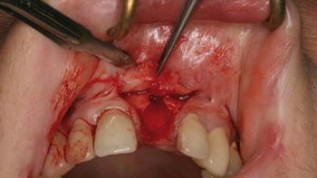 Mikrochirurgie und GBR in der Implantologie