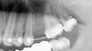 Sinuslift mit periointegrativem ­Implantat