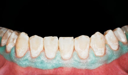 Mikro Invasive Behandlung Von Post Orthodontischen White Spots Auf Glattflachen Zwp Online Das Nachrichtenportal Fur Die Dentalbranche