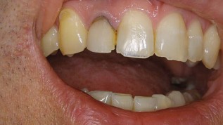 KISS Prinzipien der Ästhetischen Implantologie