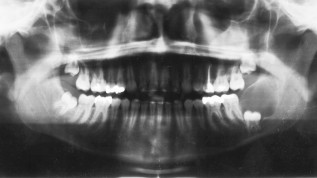 Becken­kammtransplantat als Implantatlager