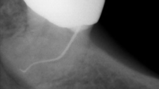 Therapie nach endodontischem Misserfolg