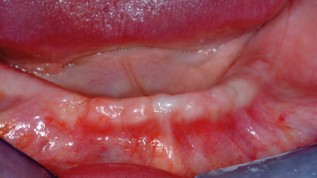 Sofortbelastung von transgingivalen ­Implantaten