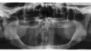 Lebensqualität im Alter durch Implantate