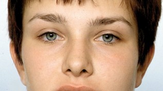 Untergesichtsverlängerung bei Klasse II-Dysgnathie