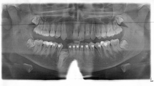 3-D-Aufnahme deckt Odontom auf
