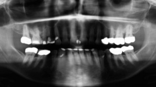 Deckung einer singulären Rezession mittels Laser