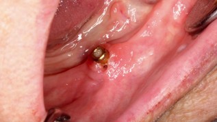 Die Entfernung eines Implantates mit Er:YAG-Laser
