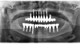 Periimplantitis - erfolgreich behandelbar?