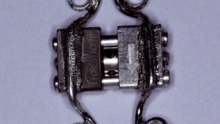 Einfache Methode zur maxillären Expansion