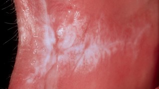 Die Leukoplakie der Mundschleimhaut