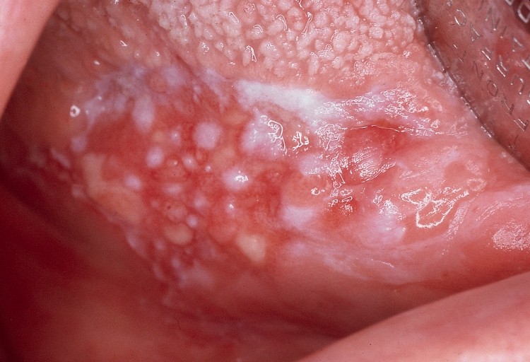 Abb.3: Erythroleukoplakie des Zungenrandes rechts mit abwechselnd weißen un...