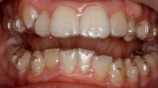 Zahnstellungskorrekturen mit Invisalign