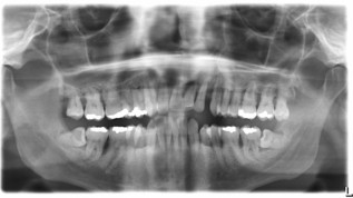 CAD/CAM-Rehabilitation im Frontzahnbereich