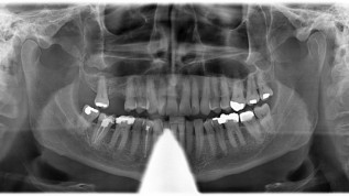 Implantat­therapie im atrophierten Oberkiefer