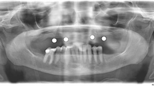 Knochen­regeneration durch neue Kollagenmembran