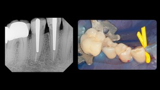 Die postendodontische Versorgung