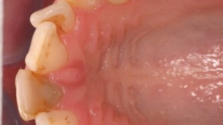 Korrektur von Zahnform mit keramischen Veneers