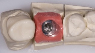 Zweiteilige Abutments, dort, wo es Sinn macht