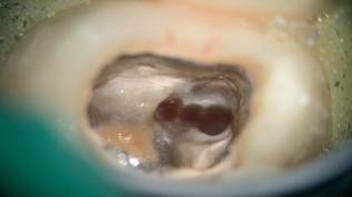 Das Potential eines Dentalmikroskops nutzen